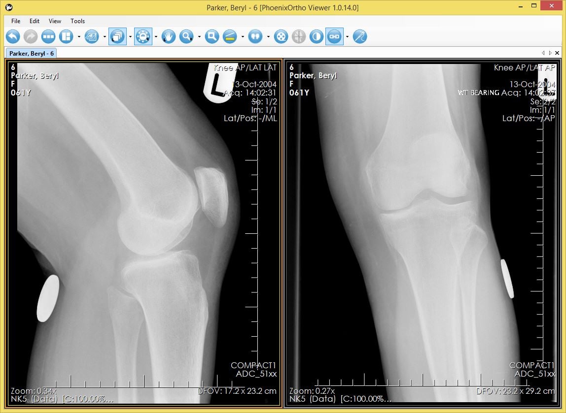 Xray Veiwer_Knee